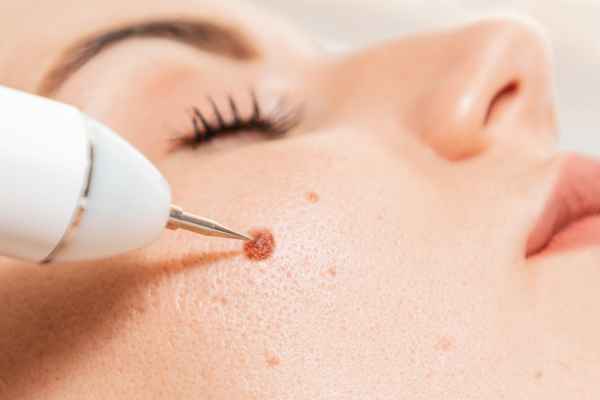 CryoPen: 5 Skin Concerns It May Be Used to Treat 3 What actually happens during a CryoPen treatment Rochdale?