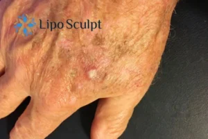 Best Actinic Keratoses Removal 2 Improve your wellbeing and health with Actinic Keratoses Rochdale removal.treatment