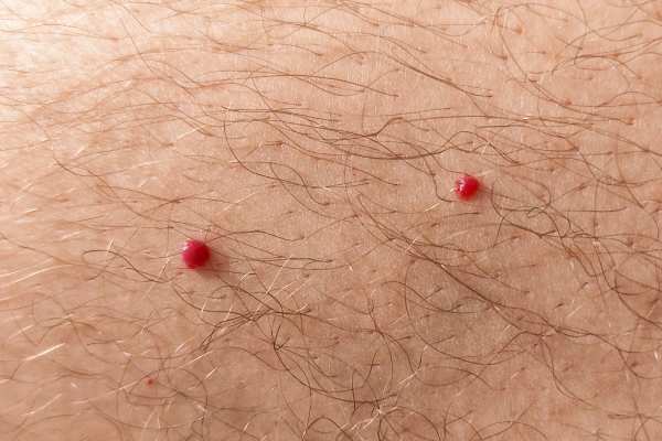 CryoPen: 5 Skin Concerns It May Be Used to Treat 2 cherry angioma removal Rochdale