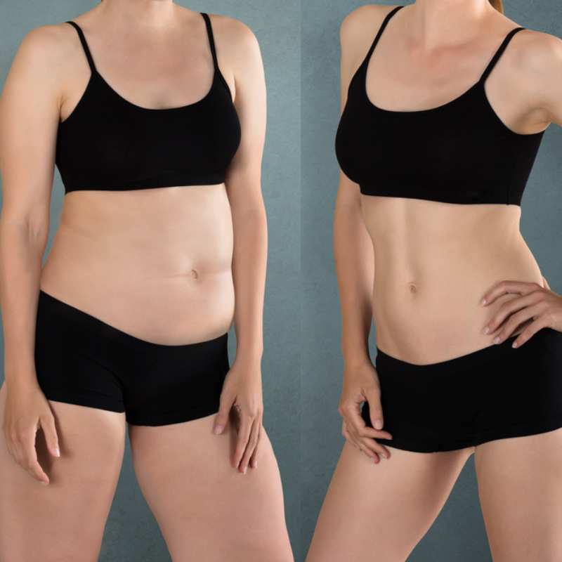 Does Fat Freezing at Home Work? DIY Devices vs Professional Cryolipolysis 2 before and after Cryolipolysis Rochdale