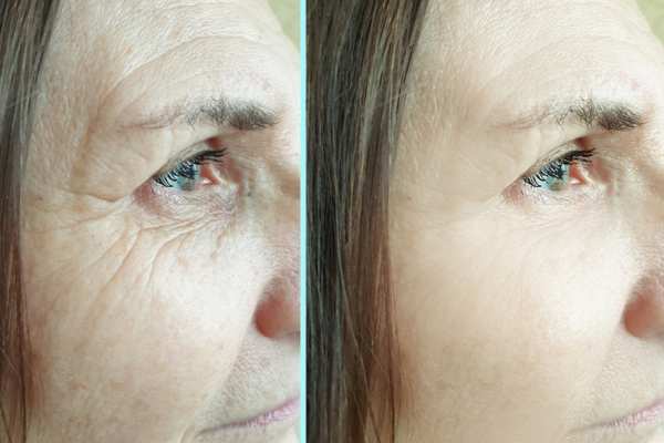 Why Do People Choose HIFU for a Non-Surgical Facelift? 4 How long can HIFU results last Rochdale?