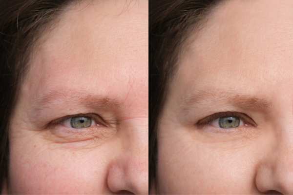 HIFU vs Botulinum Toxin: Understanding the Differences 4 How long do HIFU results last Rochdale?
