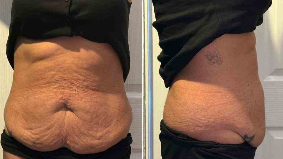 Lost the Weight but Not the Loose Skin? What You Should Know 1 Is It Definitely Loose Skin Rochdale?