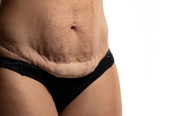 Lost the Weight but Not the Loose Skin? 1 image of womans stomach after weight loss showing loose skin Rochdale
